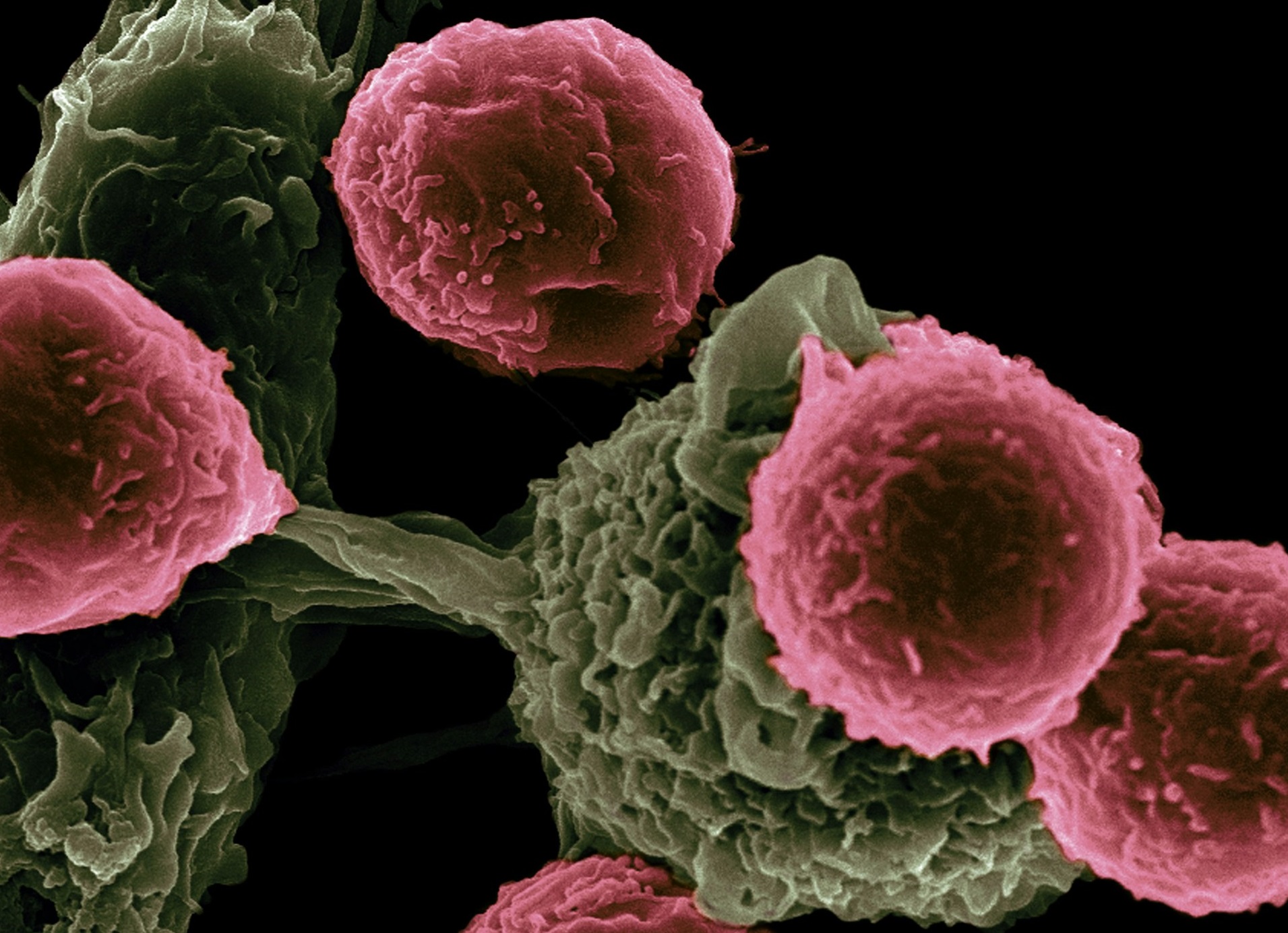 A rák fajtái, amik HPV-vírusfertőzéssel kaphatóak el